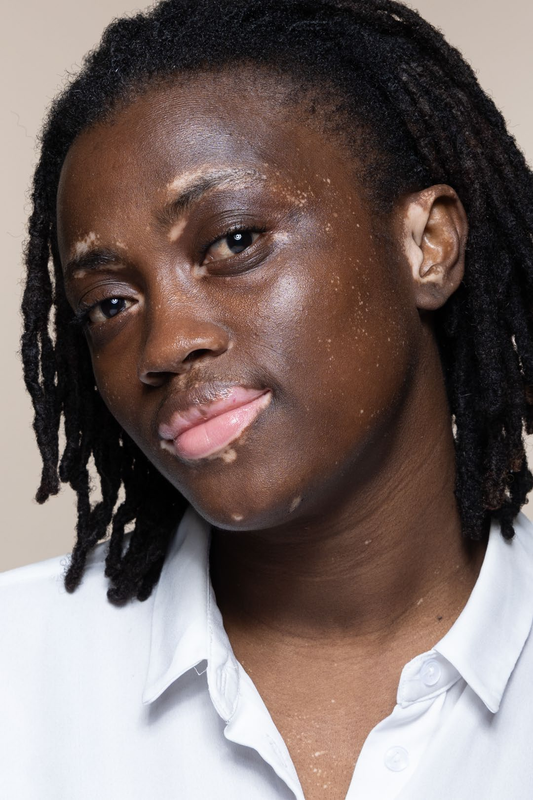 Comment mieux vivre avec le vitiligo ?