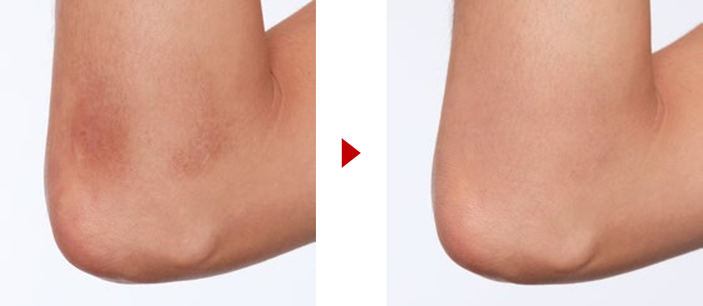 résultats avant après maquillage brûlures