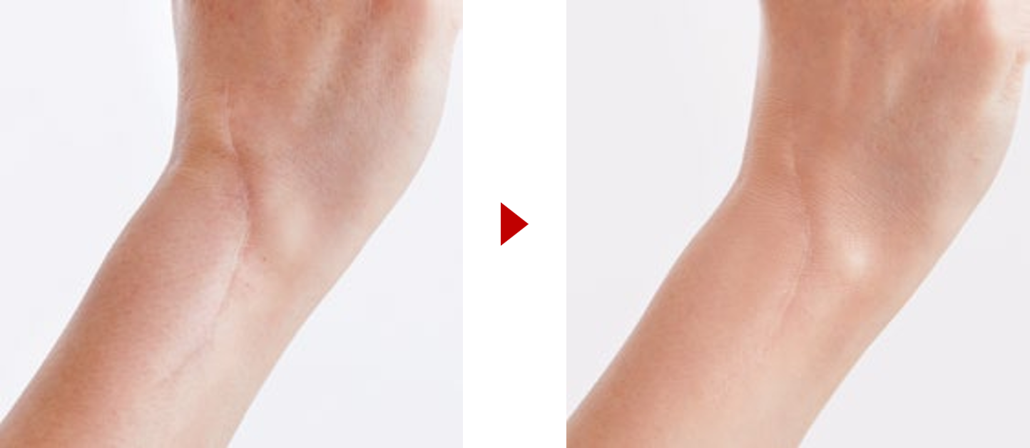 résultats avant après maquillage cicatrices