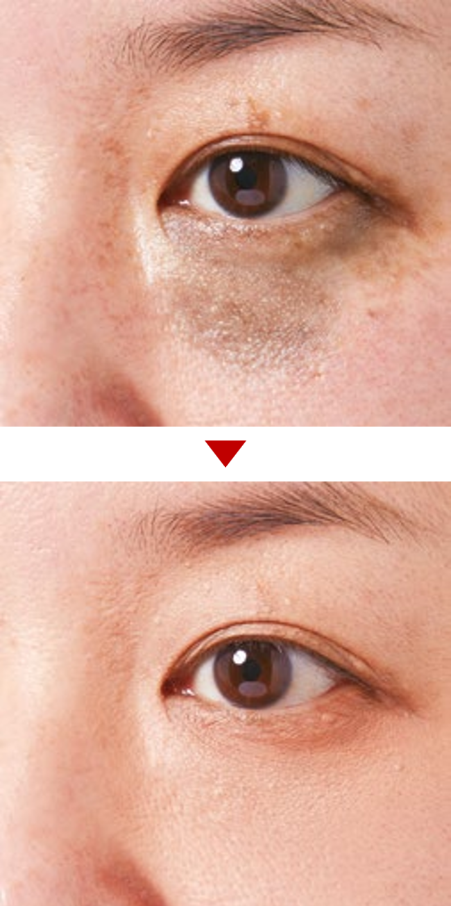 résultats avant après maquillage imperfections bleutées 