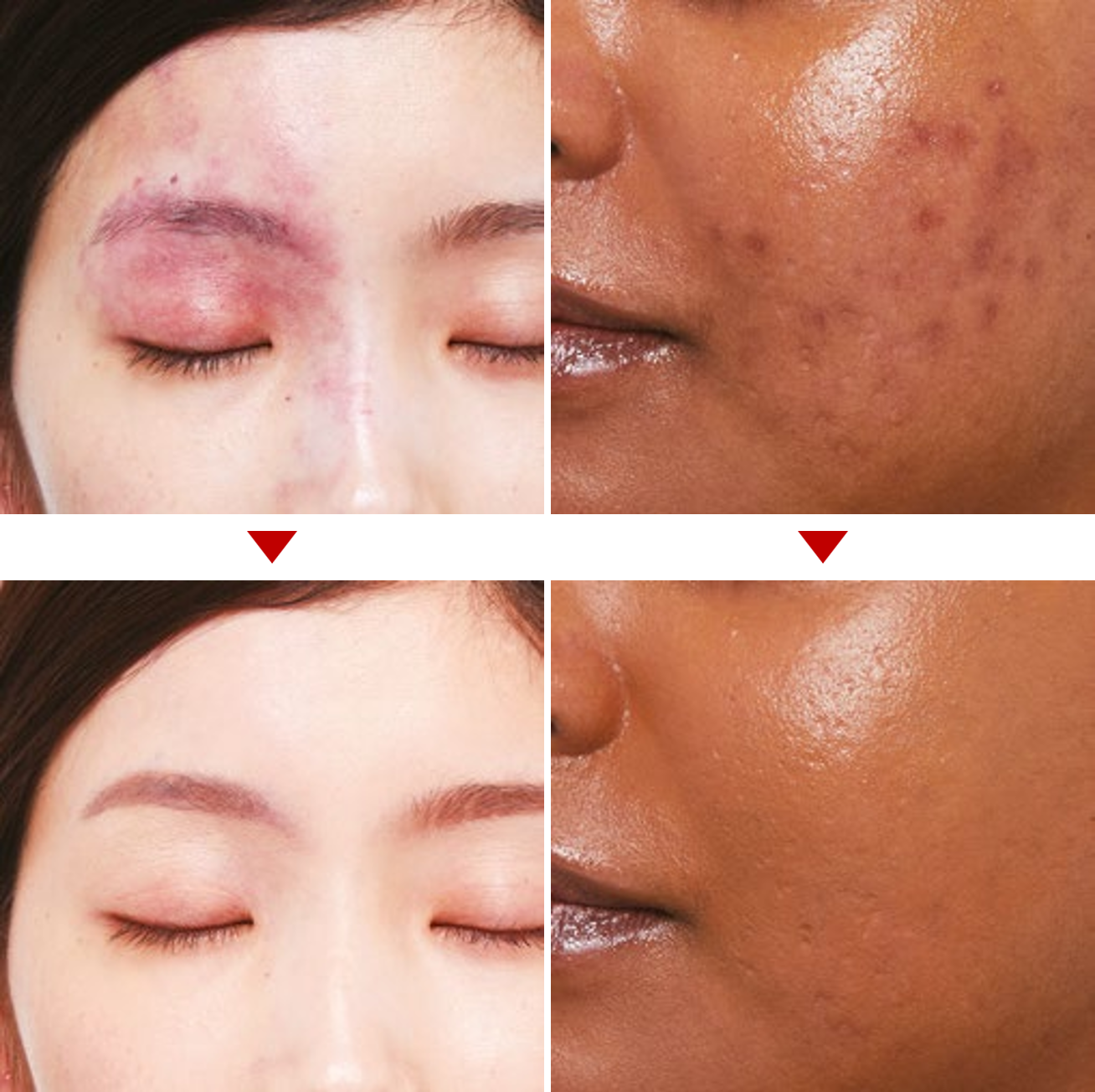 résultats avant après maquillage imperfections rougeâtres